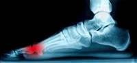 Sesamoiditis May Affect the Joints in the Big Toe