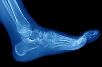 Possible Causes of Stress Fractures
