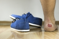 A Common Reason Blisters Develop on the Feet
