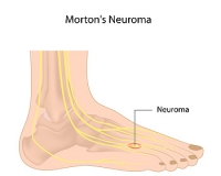 How Does Morton's Neuroma Feel?