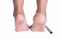 Tips to Remedy Cracked Heels