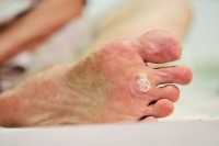 Dealing With Uncomfortable Plantar Warts