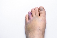 Signs and Treatments for a Broken Toe