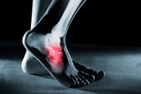 What Is A Stress Fracture?