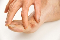 What Causes a Tailor’s Bunion?